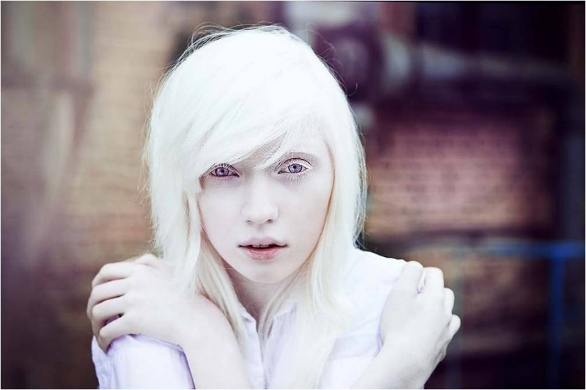 Альбинизм – ранняя старость?